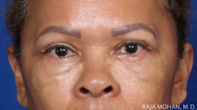 Blepharoplasty Before & After Gallery - Patient 210732 - Image 2