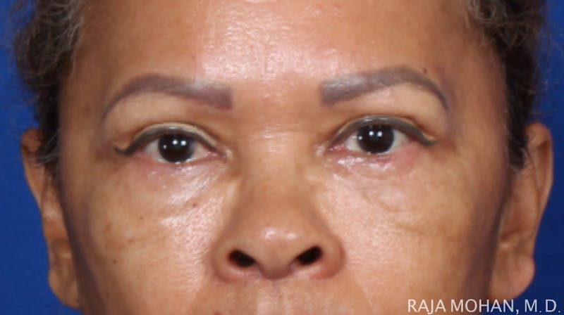 Blepharoplasty Before & After Gallery - Patient 210732 - Image 2