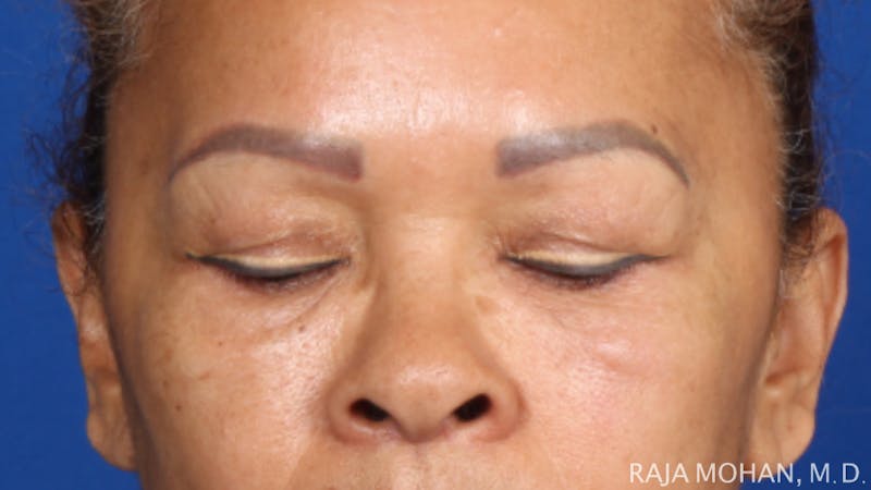 Blepharoplasty Before & After Gallery - Patient 210732 - Image 3
