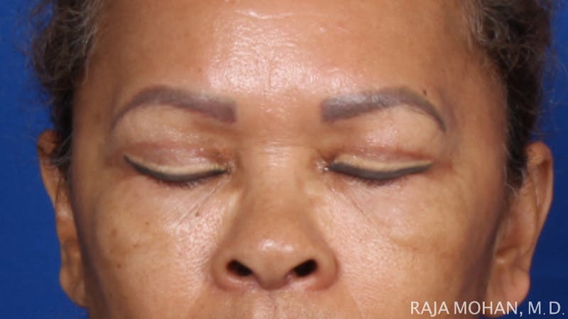 Blepharoplasty Before & After Gallery - Patient 210732 - Image 4