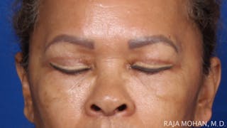Blepharoplasty Before & After Gallery - Patient 210732 - Image 4