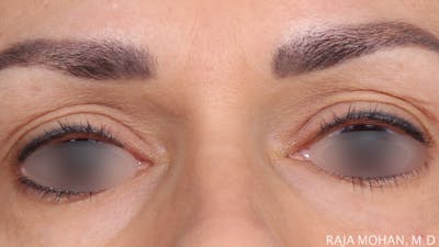 Blepharoplasty Before & After Gallery - Patient 211864 - Image 1