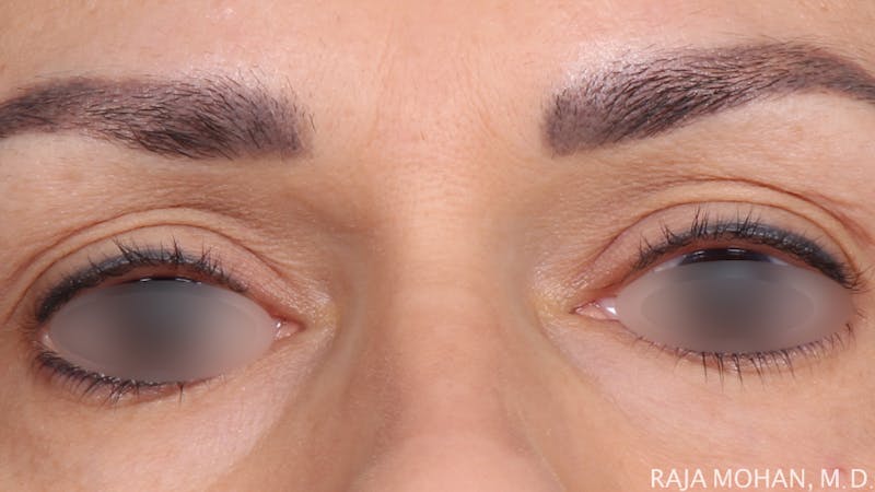 Blepharoplasty Before & After Gallery - Patient 211864 - Image 1