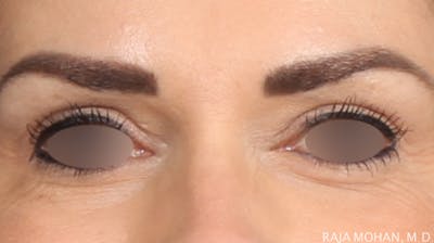 Blepharoplasty Before & After Gallery - Patient 211864 - Image 2