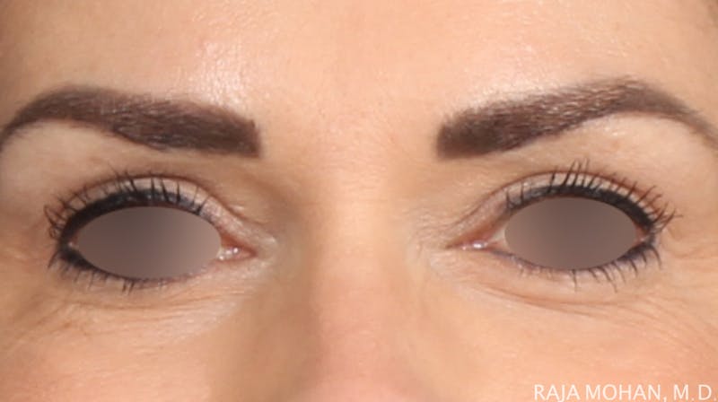 Blepharoplasty Before & After Gallery - Patient 211864 - Image 2