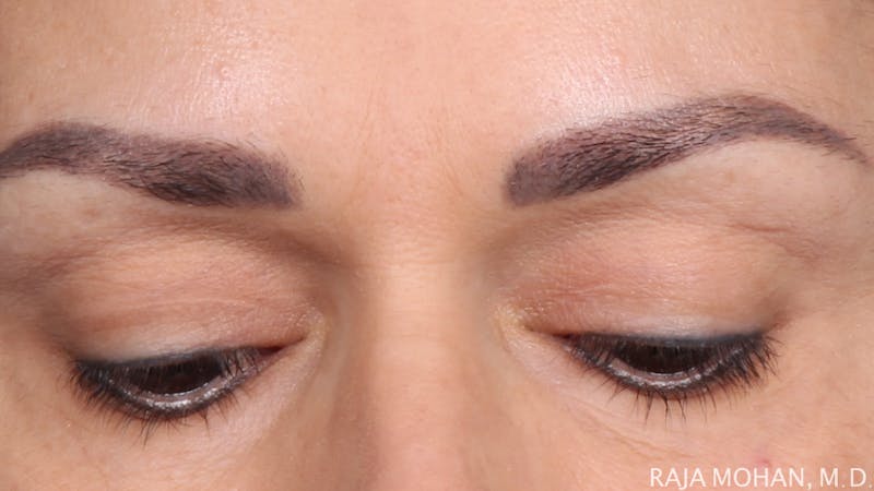 Blepharoplasty Before & After Gallery - Patient 211864 - Image 3