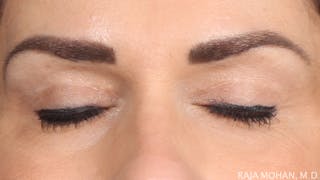 Blepharoplasty Before & After Gallery - Patient 211864 - Image 4