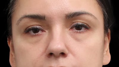 Blepharoplasty Before & After Gallery - Patient 201921 - Image 1