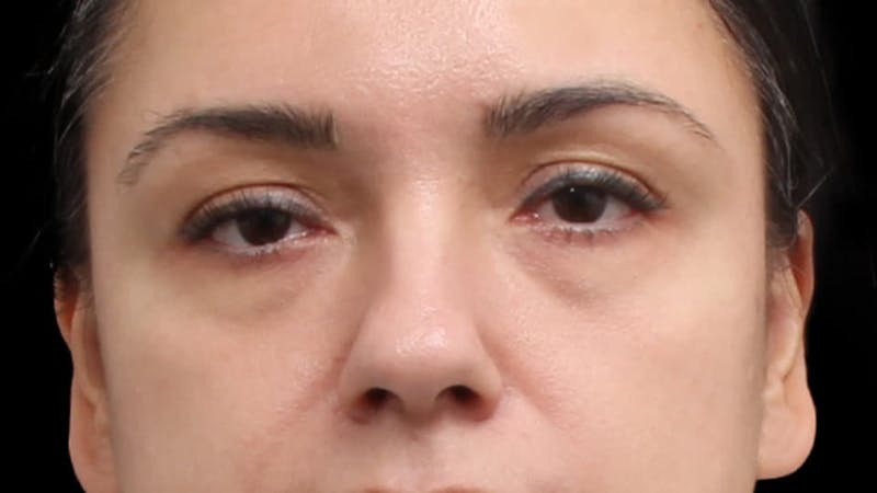 Blepharoplasty Before & After Gallery - Patient 201921 - Image 1