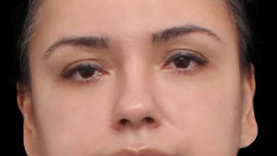 Blepharoplasty Before & After Gallery - Patient 201921 - Image 2