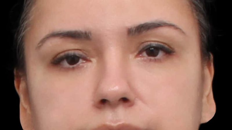 Blepharoplasty Before & After Gallery - Patient 201921 - Image 2