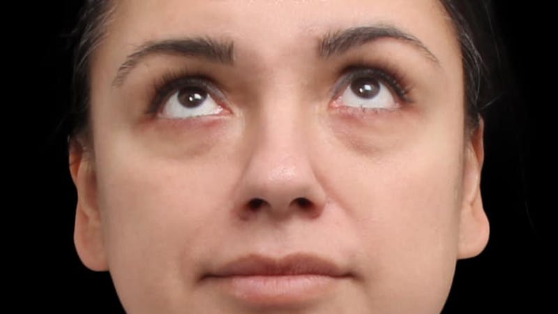 Blepharoplasty Before & After Gallery - Patient 201921 - Image 3