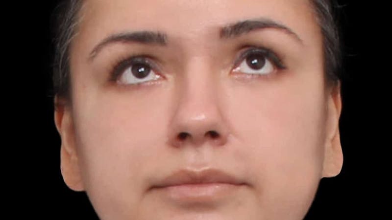 Blepharoplasty Before & After Gallery - Patient 201921 - Image 4