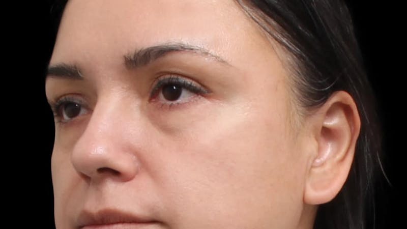 Blepharoplasty Before & After Gallery - Patient 201921 - Image 5