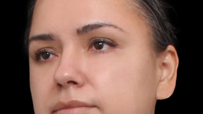 Blepharoplasty Before & After Gallery - Patient 201921 - Image 6