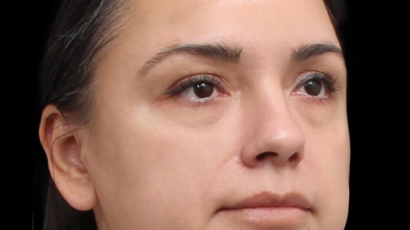 Blepharoplasty Before & After Gallery - Patient 201921 - Image 7