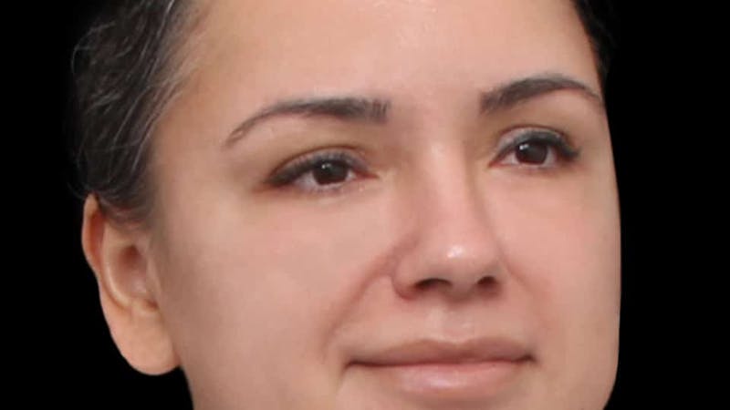 Blepharoplasty Before & After Gallery - Patient 201921 - Image 8