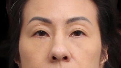 Blepharoplasty Before & After Gallery - Patient 327756 - Image 1