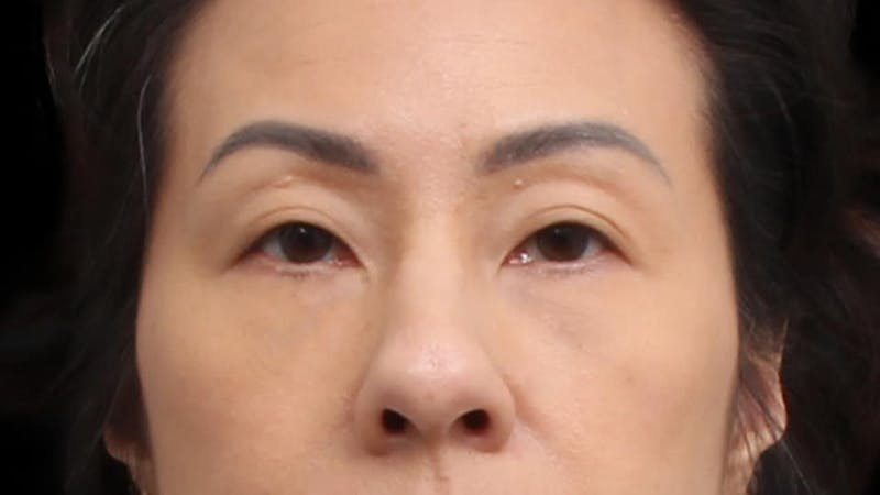 Blepharoplasty Before & After Gallery - Patient 327756 - Image 1