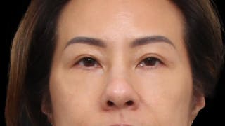 Blepharoplasty Before & After Gallery - Patient 327756 - Image 2