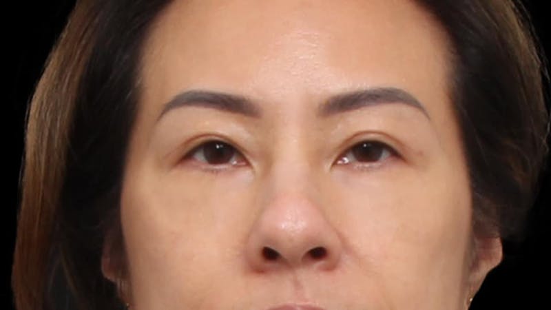 Blepharoplasty Before & After Gallery - Patient 327756 - Image 2