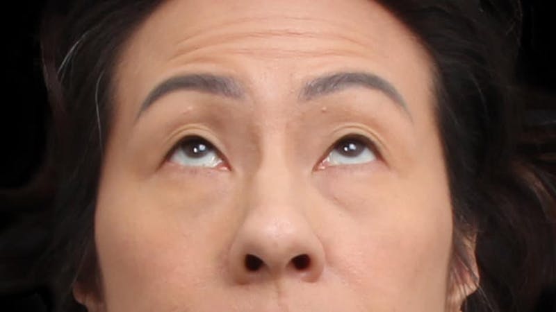 Blepharoplasty Before & After Gallery - Patient 327756 - Image 3