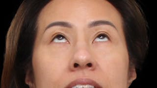 Blepharoplasty Before & After Gallery - Patient 327756 - Image 4