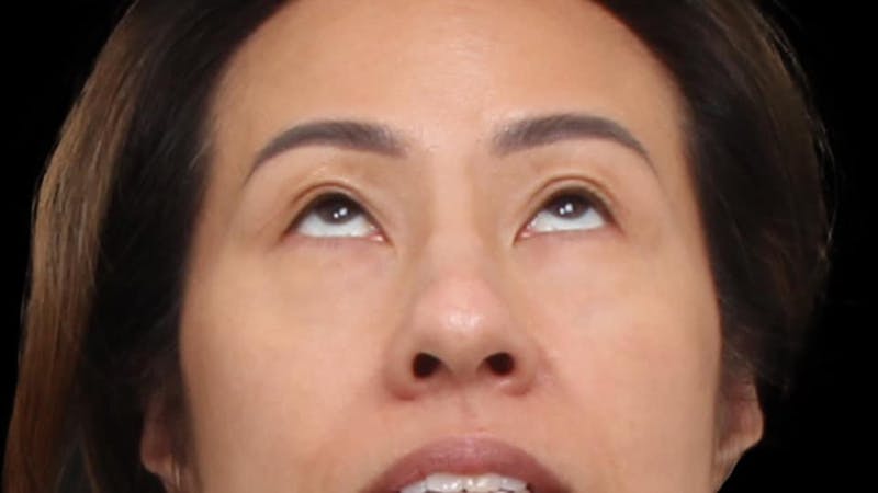 Blepharoplasty Before & After Gallery - Patient 327756 - Image 4