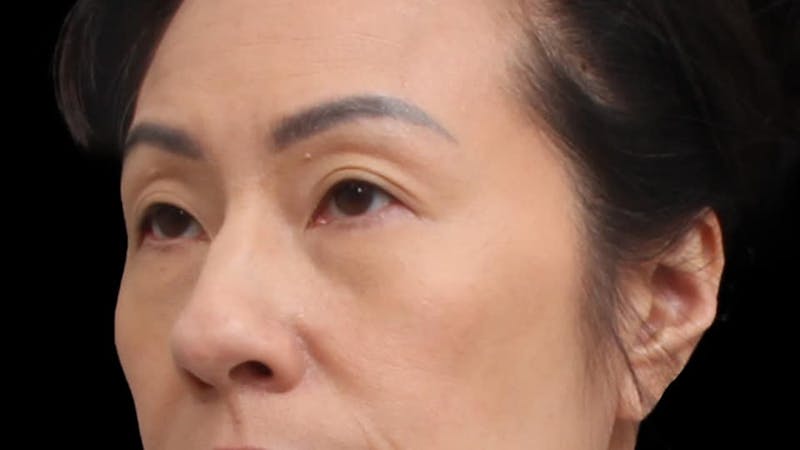 Blepharoplasty Before & After Gallery - Patient 327756 - Image 5