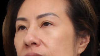 Blepharoplasty Before & After Gallery - Patient 327756 - Image 6