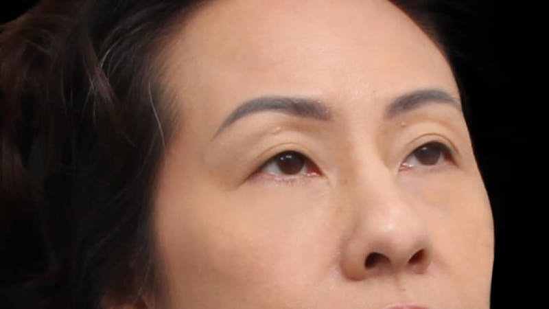 Blepharoplasty Before & After Gallery - Patient 327756 - Image 7