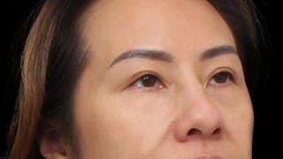 Blepharoplasty Before & After Gallery - Patient 327756 - Image 8