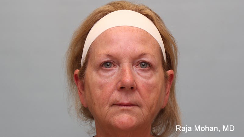 Facelift Before & After Gallery - Patient 211766 - Image 1