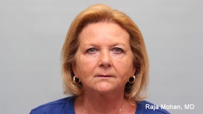 Chemical Peel Before & After Gallery - Patient 283722 - Image 2