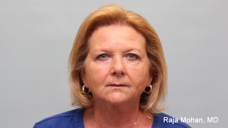 Facelift Before & After Gallery - Patient 211766 - Image 2