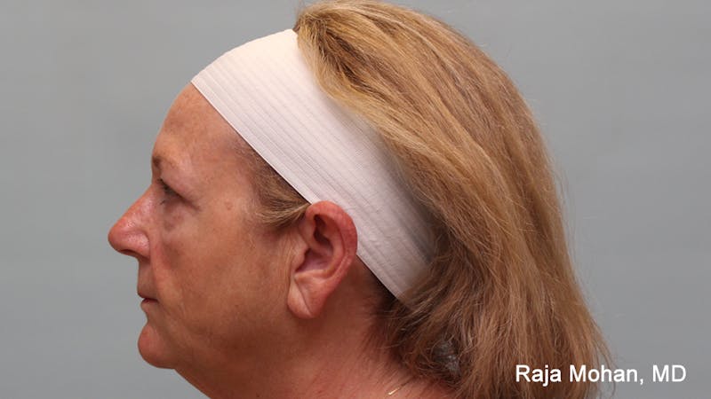 Facelift Before & After Gallery - Patient 211766 - Image 3