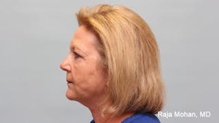 Chemical Peel Before & After Gallery - Patient 283722 - Image 4