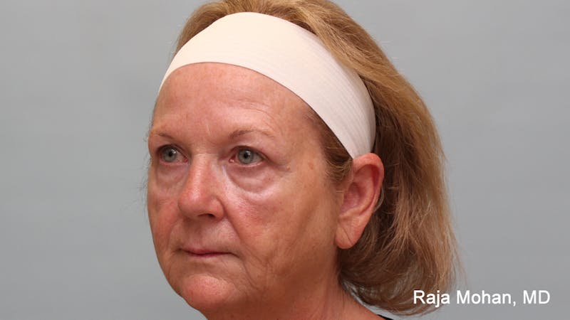 Chemical Peel Before & After Gallery - Patient 283722 - Image 5