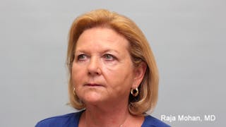 Chemical Peel Before & After Gallery - Patient 283722 - Image 6