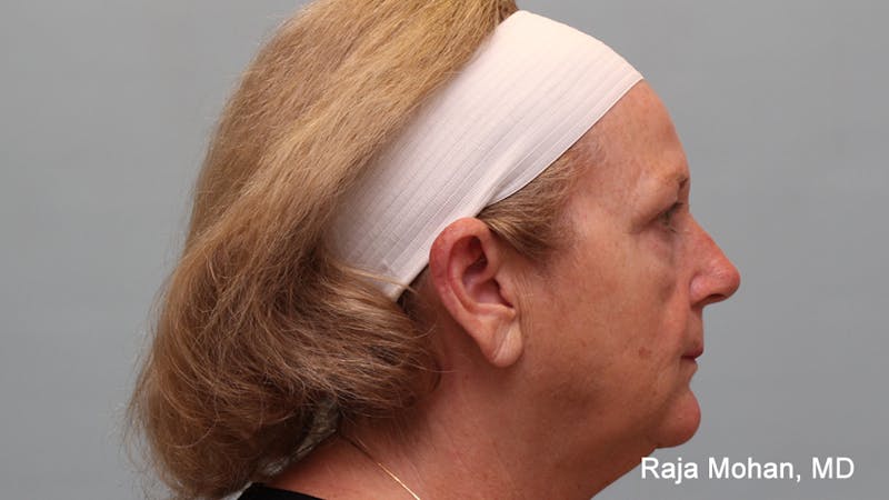 Facelift Before & After Gallery - Patient 211766 - Image 7