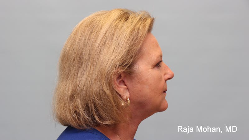 Facelift Before & After Gallery - Patient 211766 - Image 8
