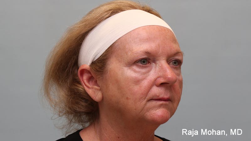 Chemical Peel Before & After Gallery - Patient 283722 - Image 9