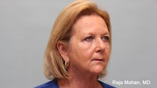 Chemical Peel Before & After Gallery - Patient 283722 - Image 10