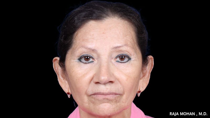 Facelift Before & After Gallery - Patient 145420 - Image 1