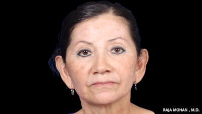 Facelift Before & After Gallery - Patient 145420 - Image 2