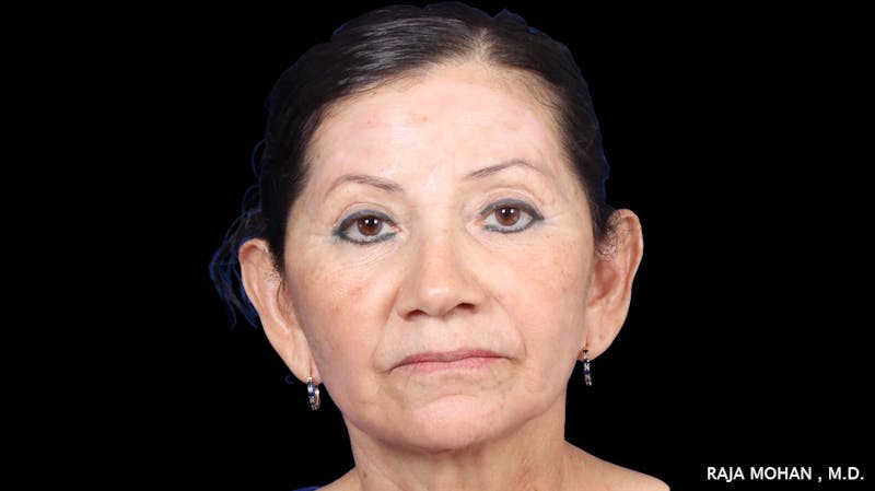 Facelift Before & After Gallery - Patient 145420 - Image 2