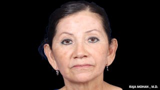 Facelift Before & After Gallery - Patient 145420 - Image 2