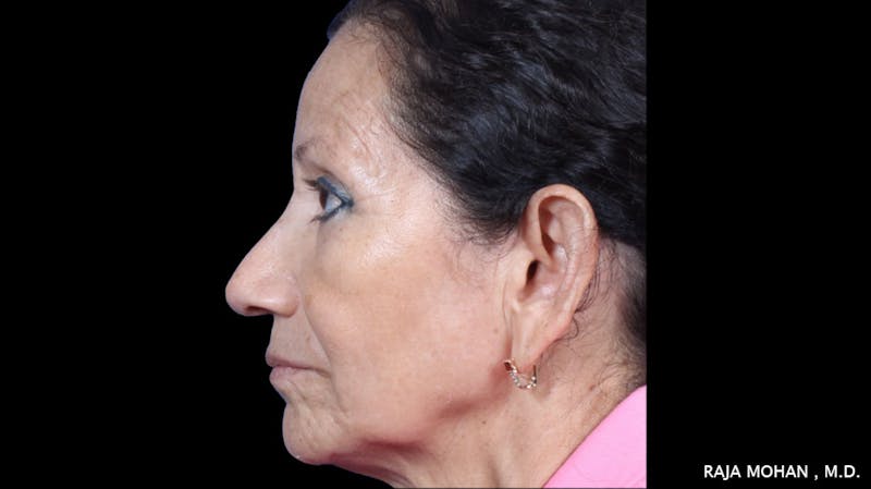 Facelift Before & After Gallery - Patient 145420 - Image 3