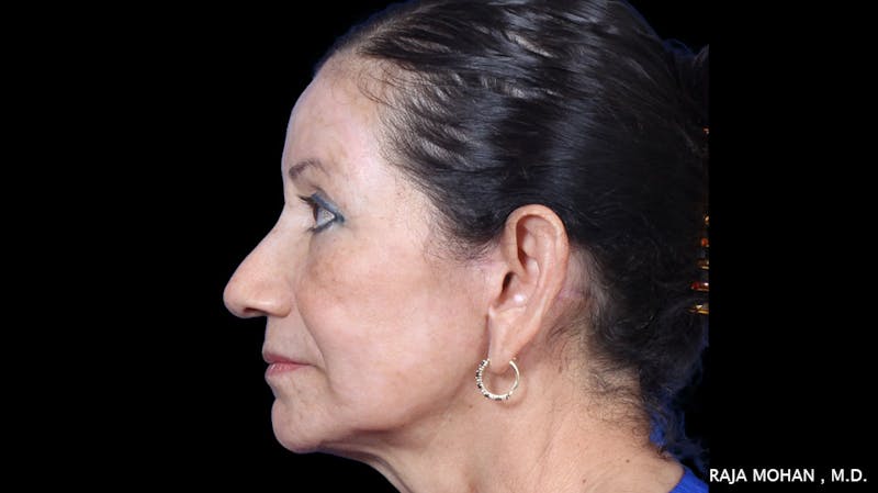 Facelift Before & After Gallery - Patient 145420 - Image 4
