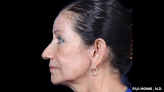 Facelift Before & After Gallery - Patient 145420 - Image 4
